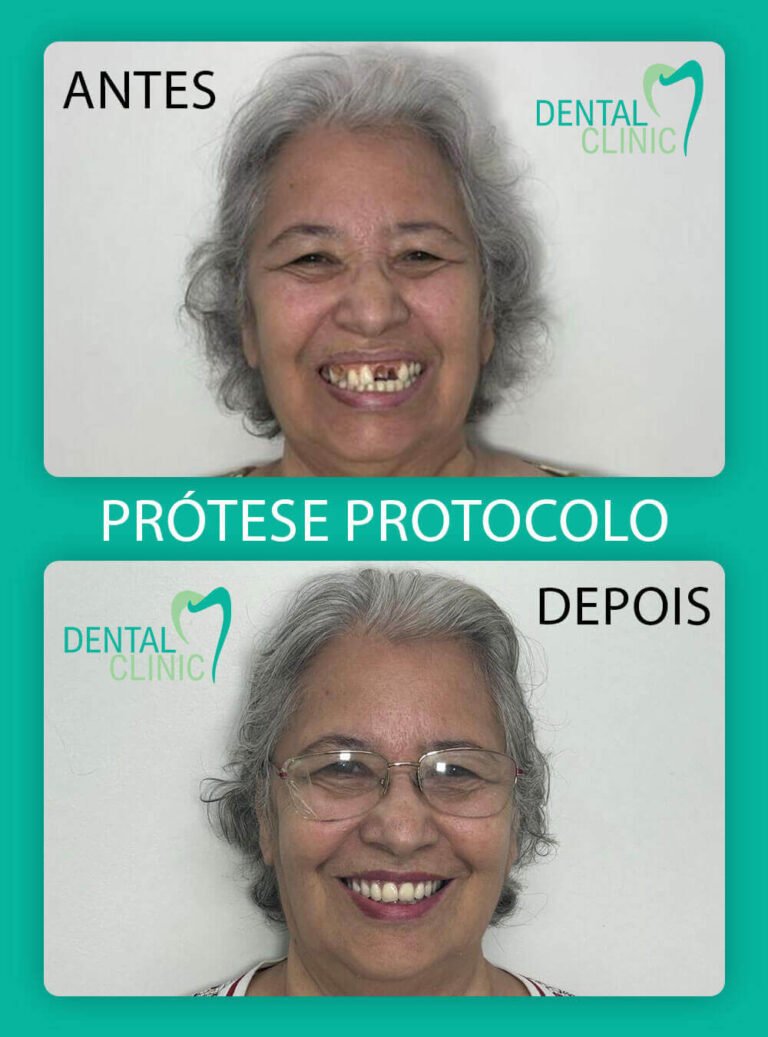 foto de resultado prótese protocolo dental clinic