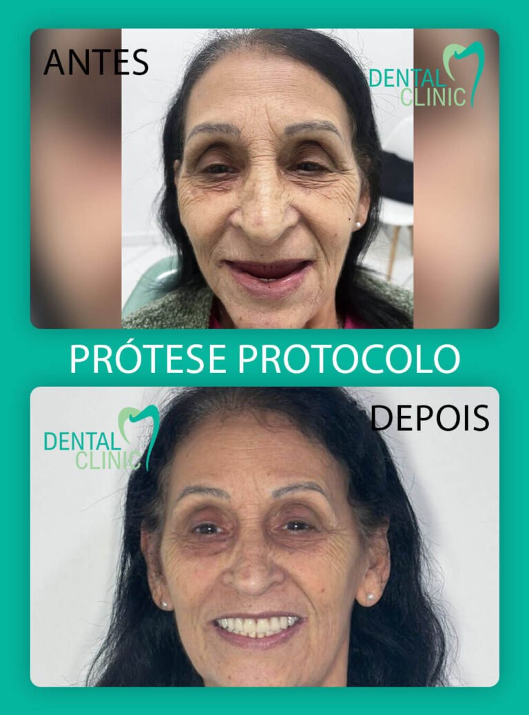 foto de resultado implante protocolo dental clinic