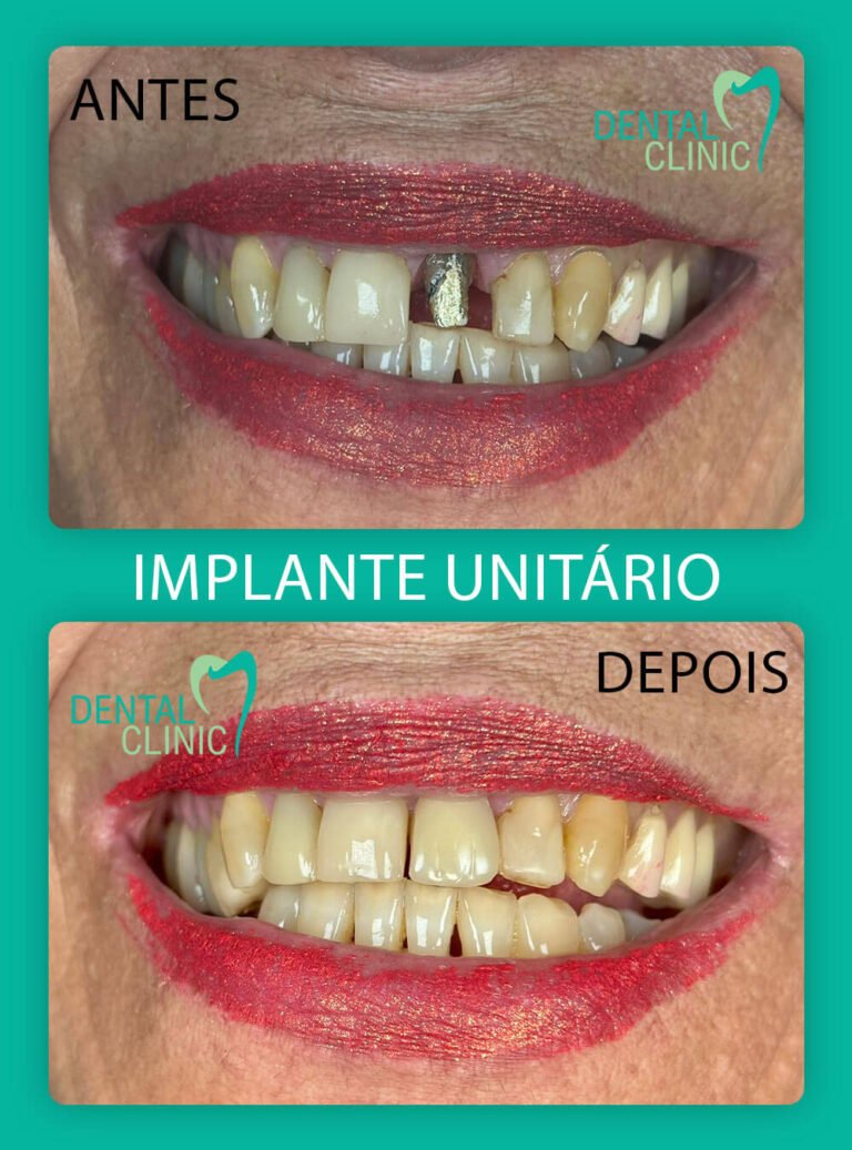 foto de resultado implante unitario dental clinic