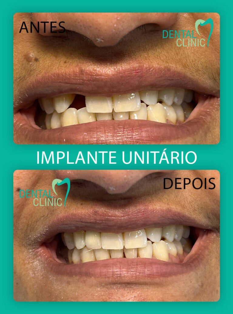 foto resultado implante unitario dental clinic