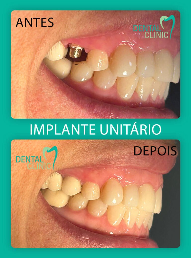 resultado implante unitario dental clinic